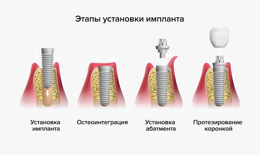 Имплантация